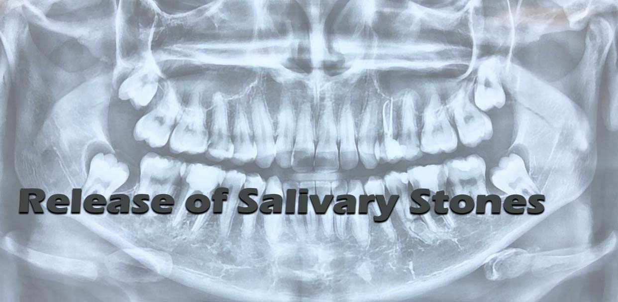 Release of Salivary Stones